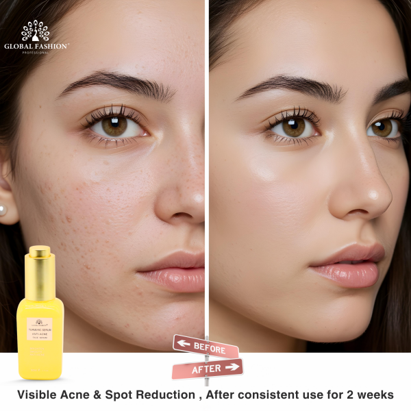 Turmeric Anti-Acne Face Serum 50ml Face Serum Bottle 50ml - Anti Aging Hydrating Skincare Serum UAE GCC | سيروم للوجه